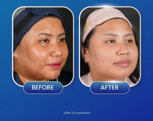 Hasil Treatment Bopeng di Sozo Skin Clinic