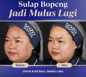 Hasil Scar Treatment di Sozo Skin Clinic