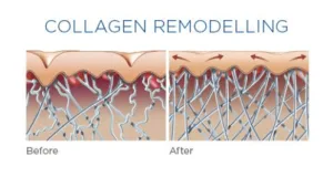 Collagen Remodeling