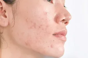 Post-Inflammatory Hyperpigmentation