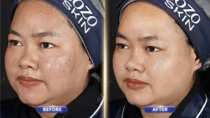Hasil Facial Treatment di Sozo Skin Clinic