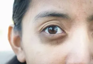 Periorbital Hyperpigmentation