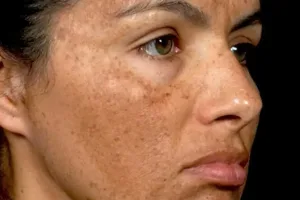 Maturational Hyperpigmentation