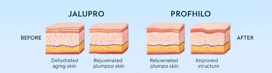 Perbedaan Jalupro vs Profhilo