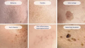 Jenis-Jenis Dark Spot