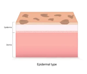 Jenis Epidermal Melasma