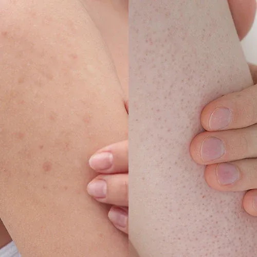 Chicken Skin (Keratosis Pilaris): Ciri, Penyebab & Cara Atasi agar Hilang