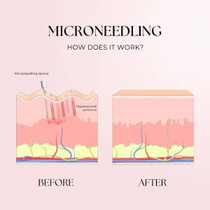 Cara Kerja Microneedling