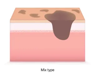 Mixed Melasma