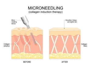 Microneedling Treatment
