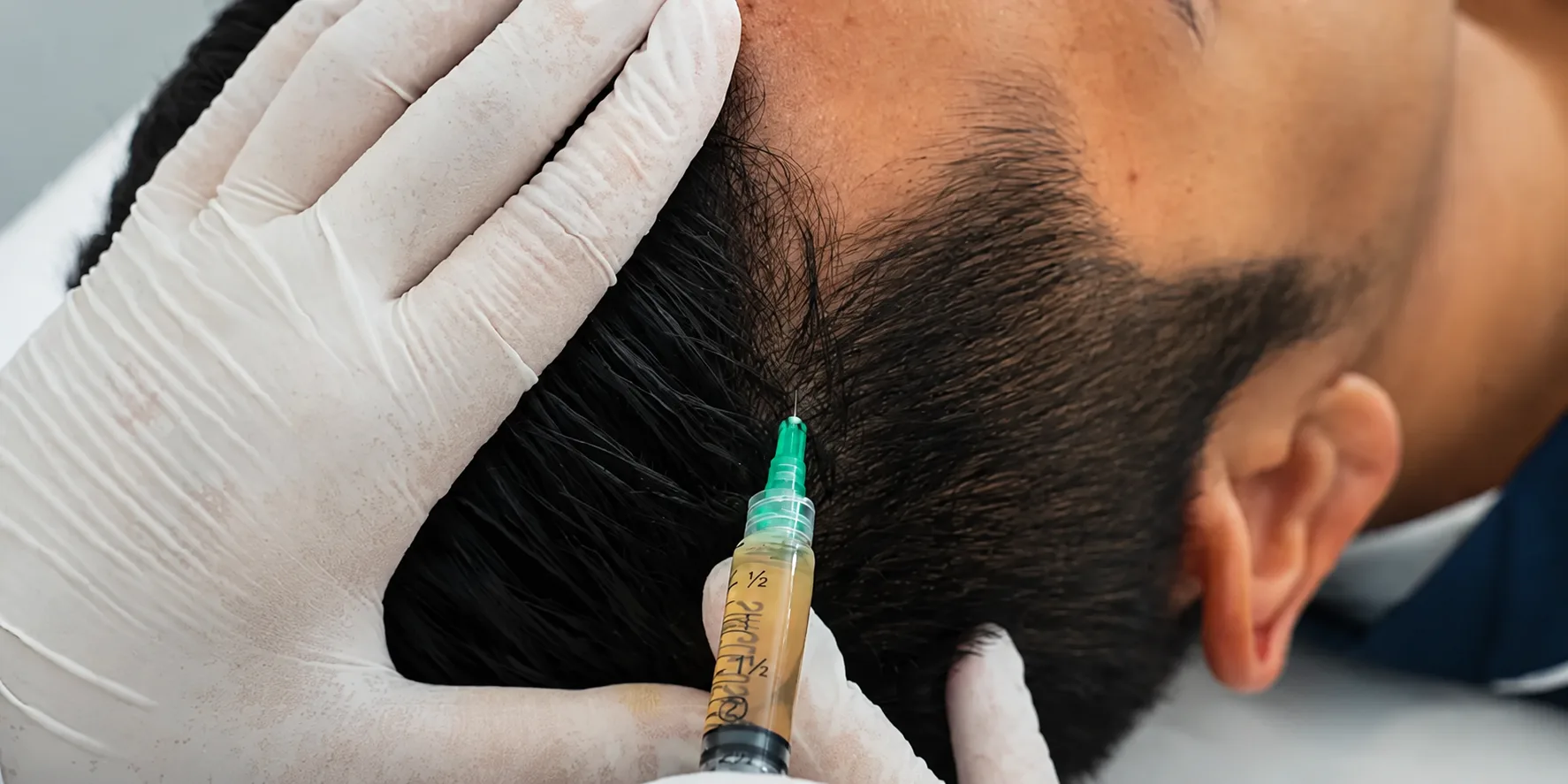10 Rekomendasi Klinik PRP Hair Treatment Terdekat dan Terpercaya