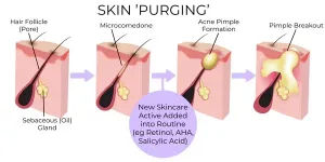 Ilustrasi Skin Purging