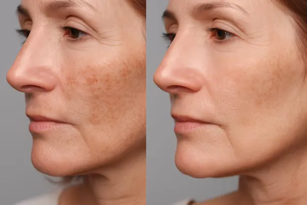 Melasma: Penyebab, Pencegahan & Treatment agar Kulit Merata