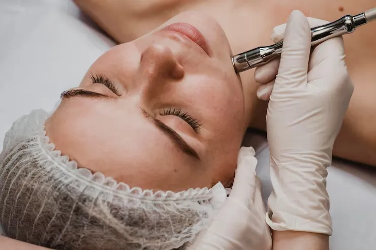 Microneedling untuk Wajah: Prosedur & Efek Samping Pasca Treatment
