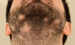 Alopecia Areata Barbae