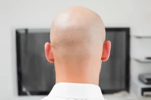 Alopecia Totalis