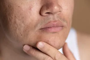 Kondisi Bekas Jerawat