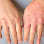 Apa Itu Dermatitis? Kenali Jenis, Gejala & Cara Mengatasinya