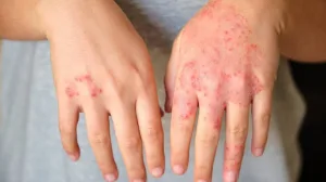 Kondisi Dermatitis