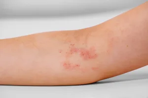 Dermatitis Atopik | Sumber: Ihosairaala