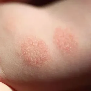 Dermatitis Numularis