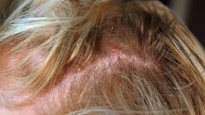 Dermatitis Seboroik
