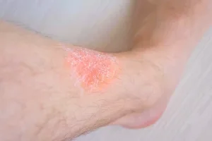 Dermatitis Stasis