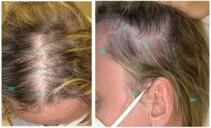 Diffuse Alopecia Areata