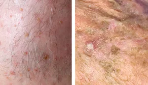 Ilustrasi Keratosis Aktinik
