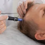 Berapa Lama Hasil Microneedling Scalp? Cek Manfaat & Risikonya!