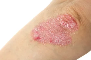 Neurodermatitis