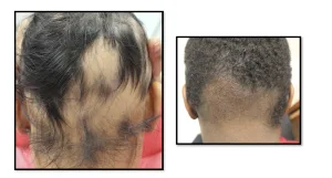 Ophiasis Alopecia Areata