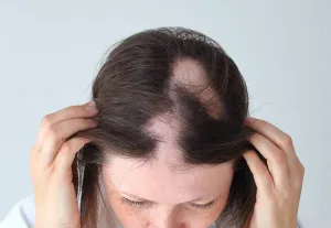 Patchy Alopecia Areata