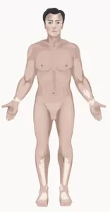 Vitiligo Acrofacial