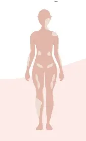 Vitiligo Campuran
