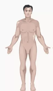 Vitiligo Fokal