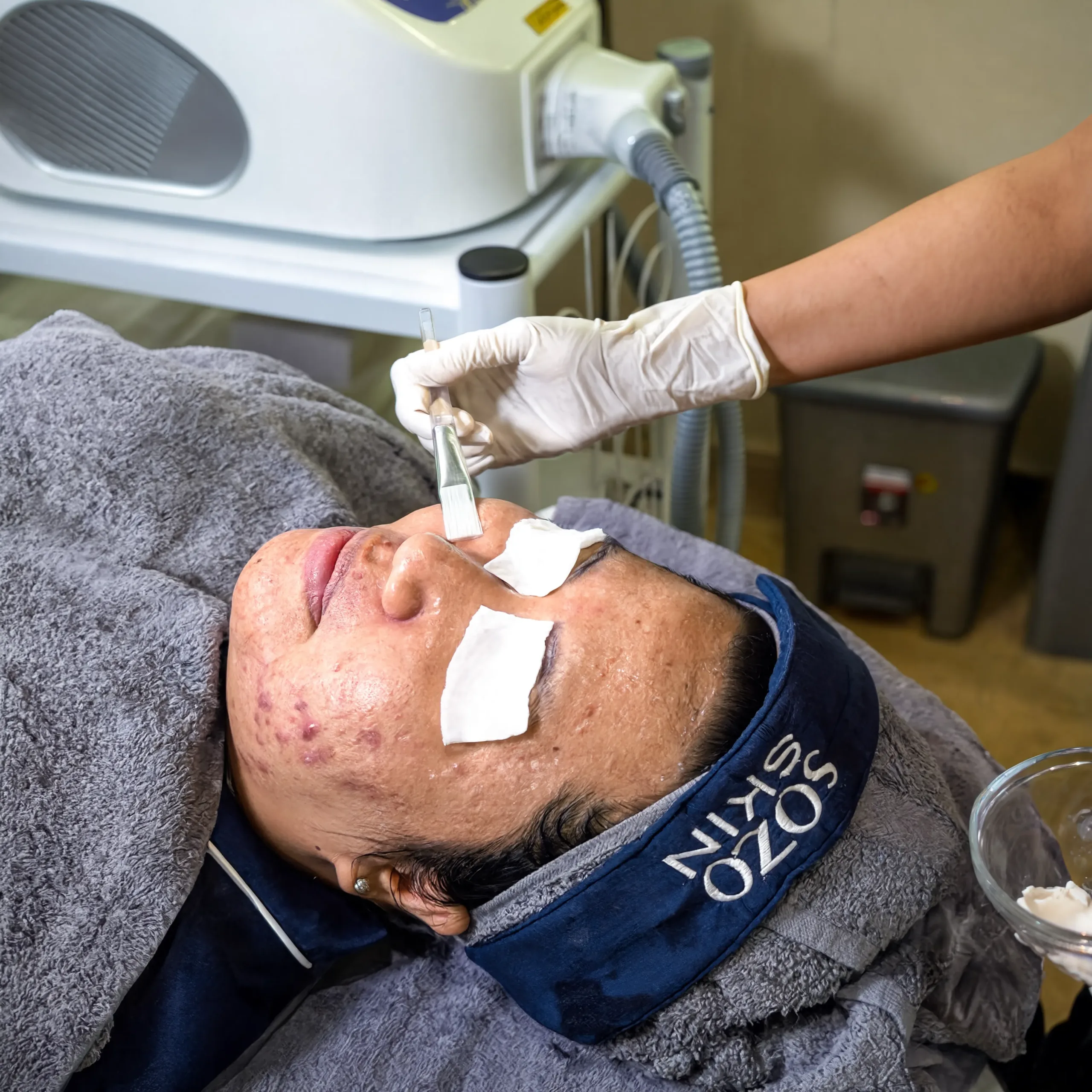 Acne Peel
