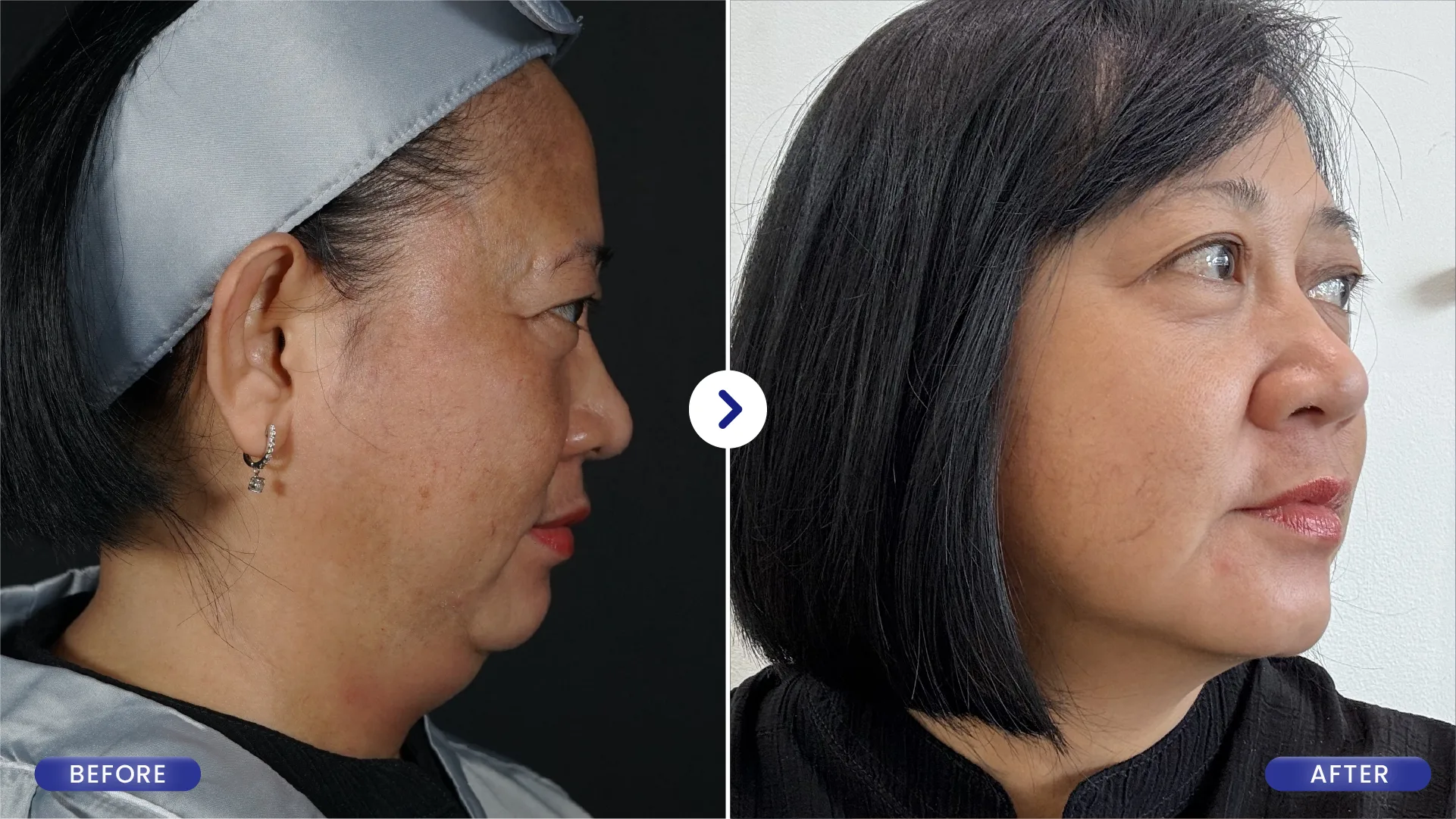 Before After Treatment SOZO Skin Clinic 2
