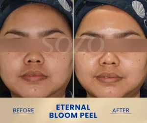 Before and After Eternal Bloom Peel di Sozo Skin Clinic
