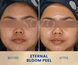 Hasil Eternal Bloom Peel Sozo Skin Clinic