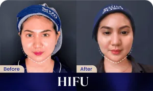 Hasil Before dan After HIFU Treatment di Sozo Skin Clinic
