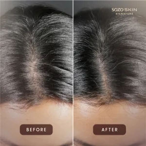 Before and After PRP Hair Treatment di Sozo Skin Clinic