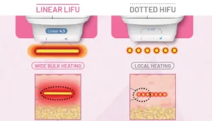 Cara Kerja Linear LIFU dan Dotted HIFU