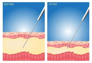 Ilustrasi Cara Kerja Meso Slim Body