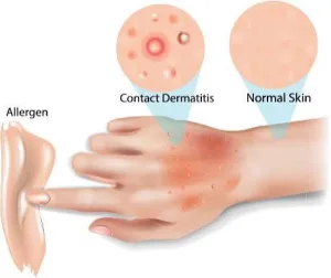 Ilustrasi Dermatitis Kontak