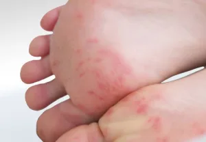 Dermatitis Kontak di Kaki
