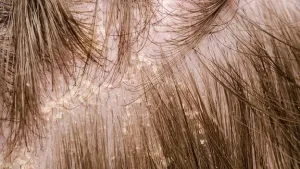 Dermatitis Kontak di Kulit Kepala