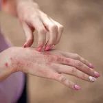 Dermatitis Kontak: Penyebab, Gejala, dan Pengobatan