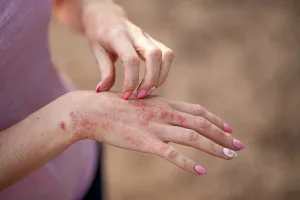 Dermatitis Kontak di Tangan