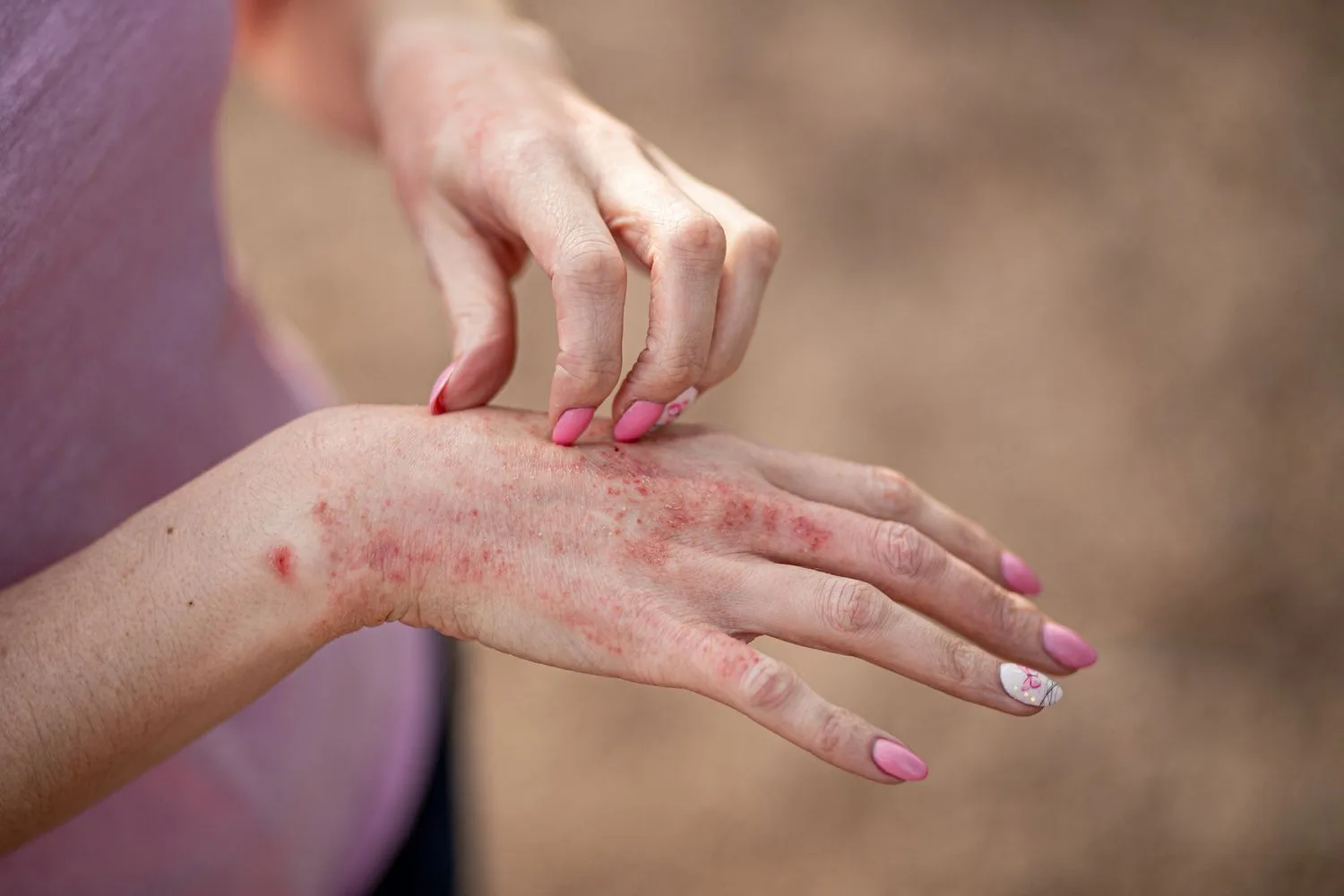 Dermatitis Kontak: Penyebab, Gejala, dan Pengobatan